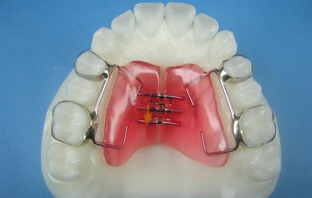 Haas Expander  Accutech Orthodontic Laboratory Products